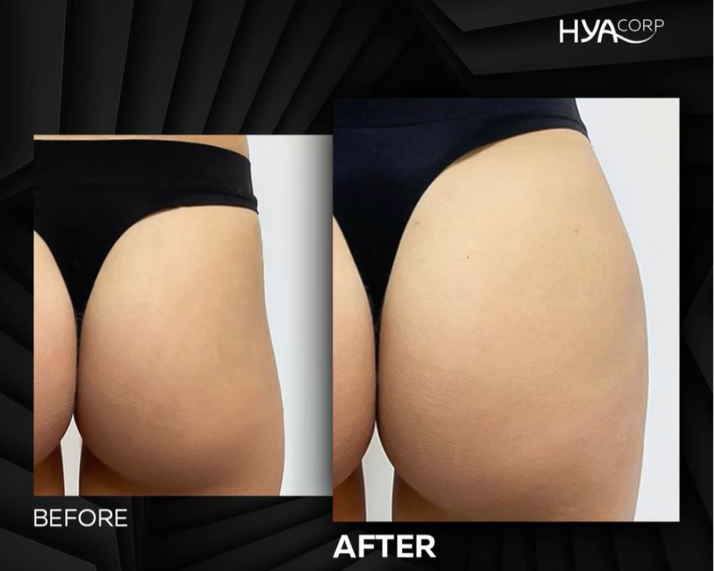 Actualizar 88+ imagen ropa interior con relleno para caderas Abzlocal.mx